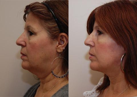 Minilift / Facelift Before and After Photos in Cincinnati, OH, Patient 6028