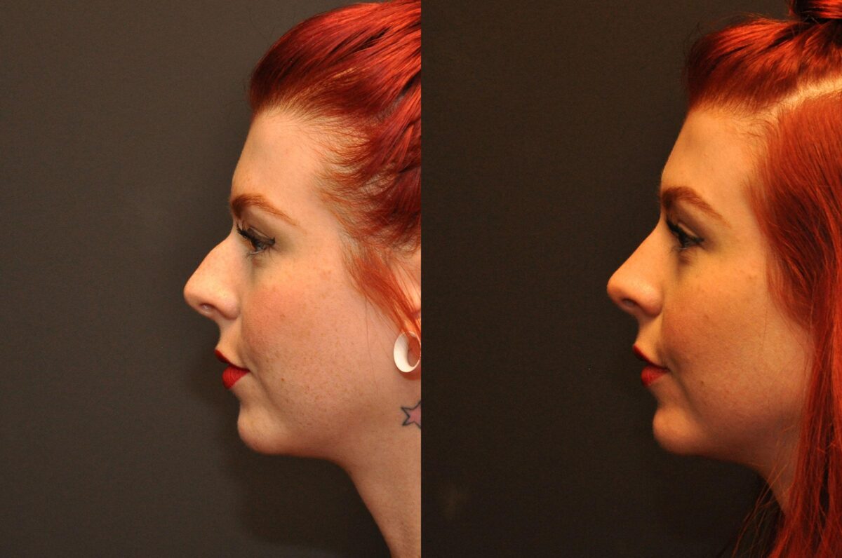 Rhinoplasty (Nose Reshaping) Before and After Photos in Cincinnati, OH, Patient 6814