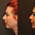 Rhinoplasty (Nose Reshaping) Before and After Photos in Cincinnati, OH, Patient 6814