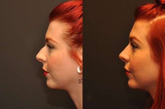 Rhinoplasty (Nose Reshaping) Before and After Photos in Cincinnati, OH, Patient 6814