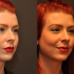 Rhinoplasty (Nose Reshaping) Before and After Photos in Cincinnati, OH, Patient 6814