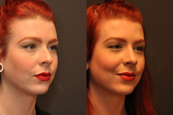 Rhinoplasty (Nose Reshaping) Before and After Photos in Cincinnati, OH, Patient 6814