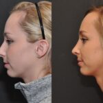 Rhinoplasty (Nose Reshaping) Before and After Photos in Cincinnati, OH, Patient 6822