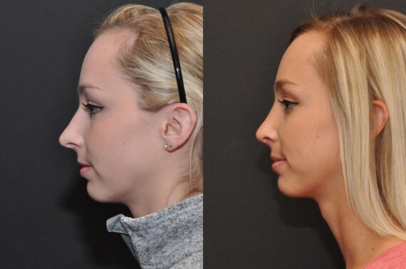 Rhinoplasty (Nose Reshaping) Before and After Photos in Cincinnati, OH, Patient 6822