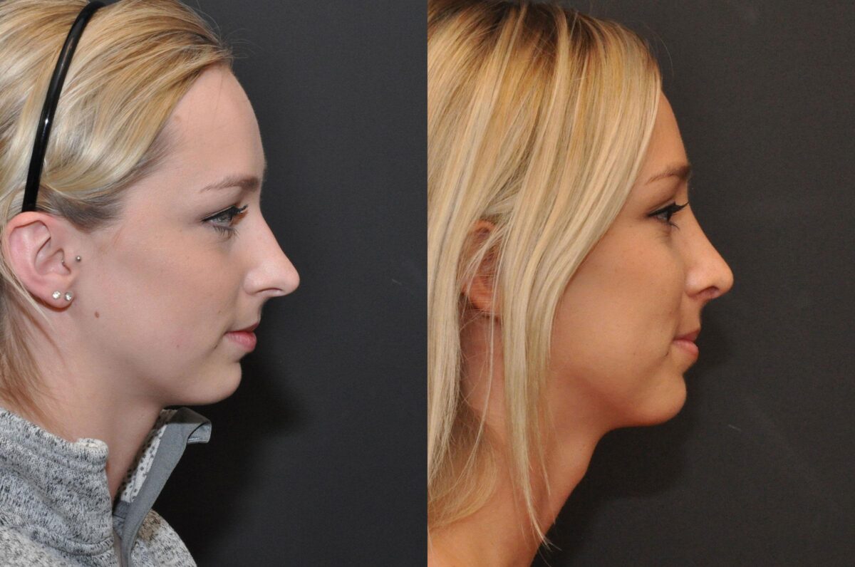 Rhinoplasty (Nose Reshaping) Before and After Photos in Cincinnati, OH, Patient 6822