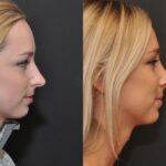Rhinoplasty (Nose Reshaping) Before and After Photos in Cincinnati, OH, Patient 6822