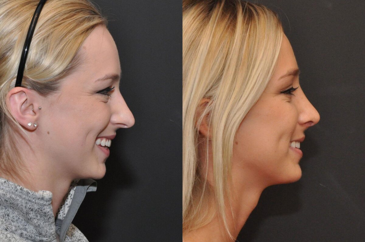 Rhinoplasty (Nose Reshaping) Before and After Photos in Cincinnati, OH, Patient 6822