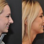 Rhinoplasty (Nose Reshaping) Before and After Photos in Cincinnati, OH, Patient 6822
