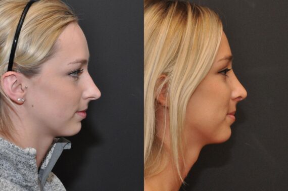 Rhinoplasty (Nose Reshaping) Before and After Photos in Cincinnati, OH, Patient 6822