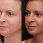 Facial Liposuction Before and After Photos in Cincinnati, OH, Patient 6846