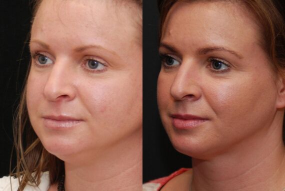 Facial Liposuction Before and After Photos in Cincinnati, OH, Patient 6846