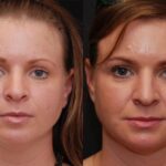 Facial Liposuction Before and After Photos in Cincinnati, OH, Patient 6846