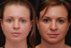 Facial Liposuction Before and After Photos in Cincinnati, OH, Patient 6846