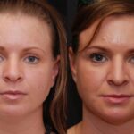 Fat Transfer Before and After Photos in Cincinnati, OH, Patient 6853