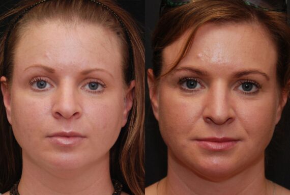 Fat Transfer Before and After Photos in Cincinnati, OH, Patient 6853