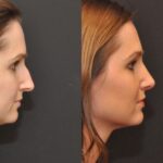 Rhinoplasty (Nose Reshaping) Before and After Photos in Cincinnati, OH, Patient 6860