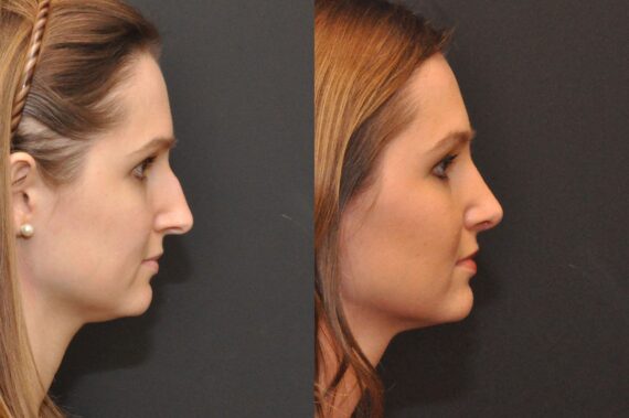 Rhinoplasty (Nose Reshaping) Before and After Photos in Cincinnati, OH, Patient 6860