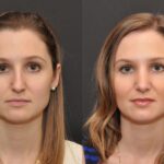 Rhinoplasty (Nose Reshaping) Before and After Photos in Cincinnati, OH, Patient 6860