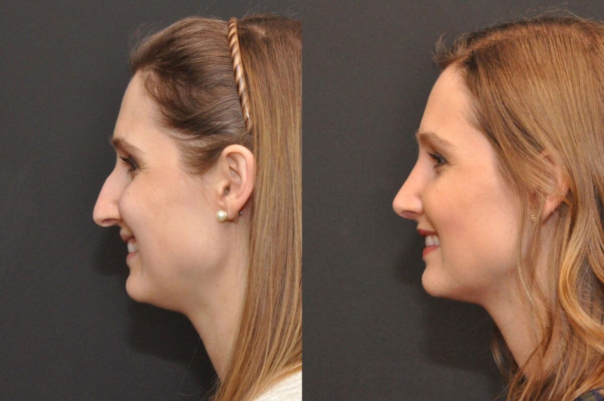 Rhinoplasty (Nose Reshaping) Before and After Photos in Cincinnati, OH, Patient 6860