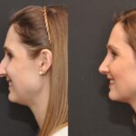 Rhinoplasty (Nose Reshaping) Before and After Photos in Cincinnati, OH, Patient 6860