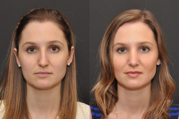 Rhinoplasty (Nose Reshaping) Before and After Photos in Cincinnati, OH, Patient 6860