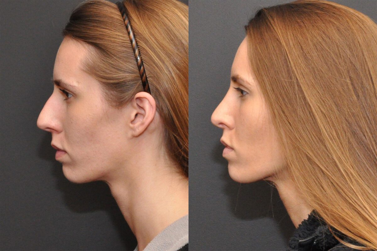 Rhinoplasty (Nose Reshaping) Before and After Photos in Cincinnati, OH, Patient 6870