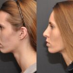 Rhinoplasty (Nose Reshaping) Before and After Photos in Cincinnati, OH, Patient 6870