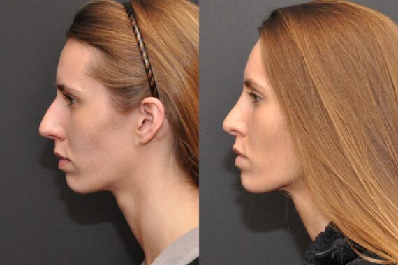 Rhinoplasty (Nose Reshaping) Before and After Photos in Cincinnati, OH, Patient 6870