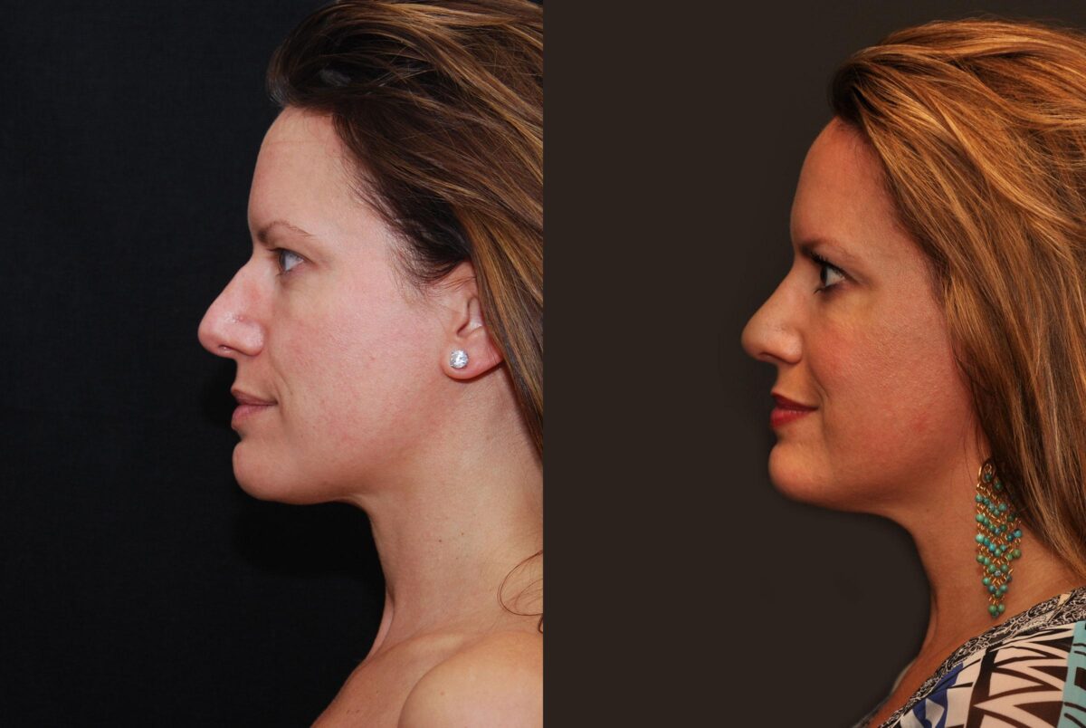 Rhinoplasty (Nose Reshaping) Before and After Photos in Cincinnati, OH, Patient 6875