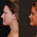 Rhinoplasty (Nose Reshaping) Before and After Photos in Cincinnati, OH, Patient 6875