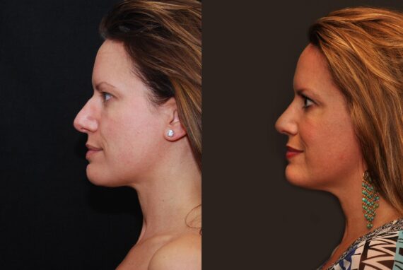 Rhinoplasty (Nose Reshaping) Before and After Photos in Cincinnati, OH, Patient 6875