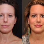Rhinoplasty (Nose Reshaping) Before and After Photos in Cincinnati, OH, Patient 6875