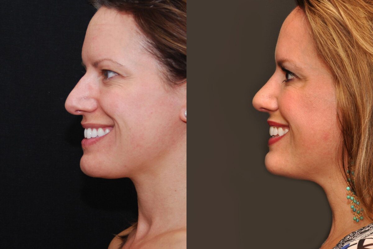 Rhinoplasty (Nose Reshaping) Before and After Photos in Cincinnati, OH, Patient 6875