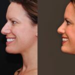 Rhinoplasty (Nose Reshaping) Before and After Photos in Cincinnati, OH, Patient 6875
