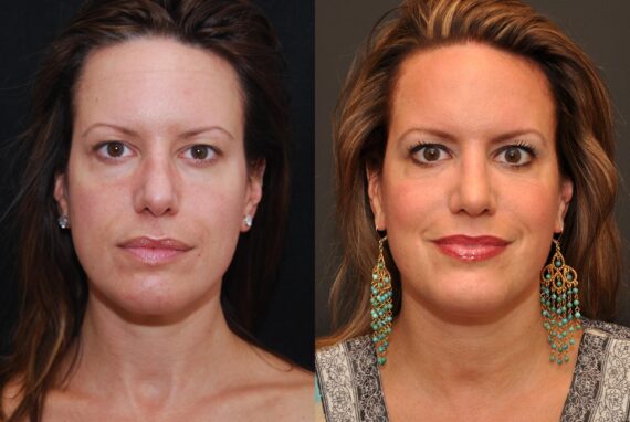 Rhinoplasty (Nose Reshaping) Before and After Photos in Cincinnati, OH, Patient 6875