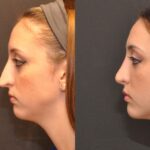 Rhinoplasty (Nose Reshaping) Before and After Photos in Cincinnati, OH, Patient 6885
