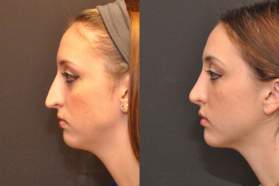 Rhinoplasty (Nose Reshaping) Before and After Photos in Cincinnati, OH, Patient 6885