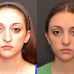 Rhinoplasty (Nose Reshaping) Before and After Photos in Cincinnati, OH, Patient 6885