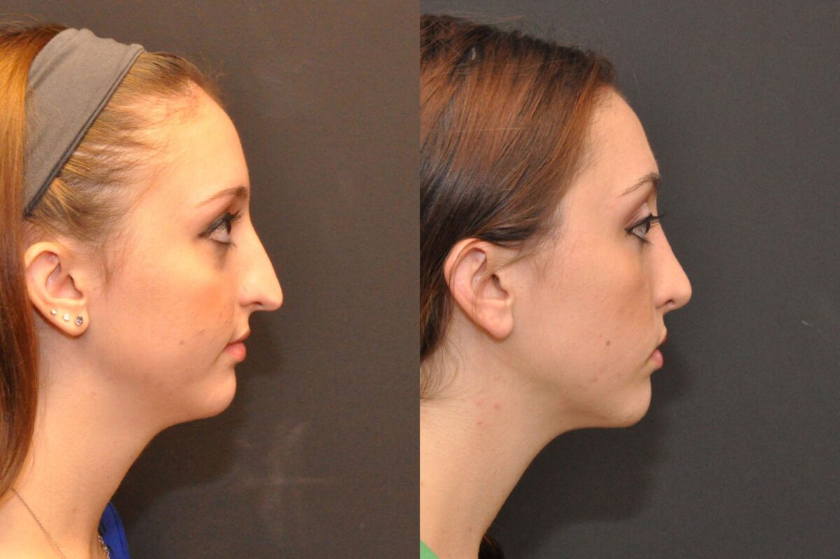 Rhinoplasty (Nose Reshaping) Before and After Photos in Cincinnati, OH, Patient 6885