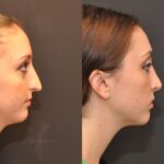 Rhinoplasty (Nose Reshaping) Before and After Photos in Cincinnati, OH, Patient 6885