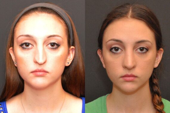 Rhinoplasty (Nose Reshaping) Before and After Photos in Cincinnati, OH, Patient 6885