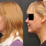 Rhinoplasty (Nose Reshaping) Before and After Photos in Cincinnati, OH, Patient 6975