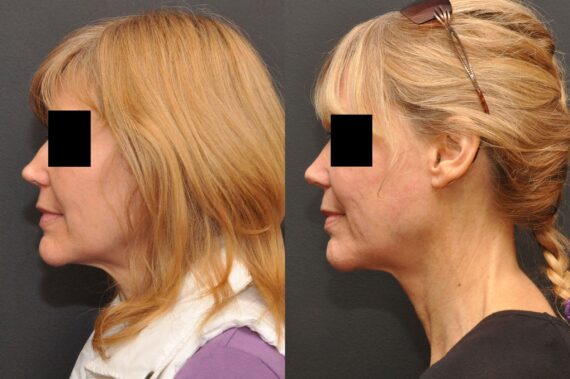 Rhinoplasty (Nose Reshaping) Before and After Photos in Cincinnati, OH, Patient 6975