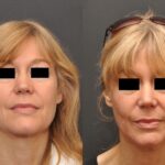 Rhinoplasty (Nose Reshaping) Before and After Photos in Cincinnati, OH, Patient 6975