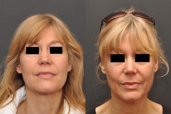 Rhinoplasty (Nose Reshaping) Before and After Photos in Cincinnati, OH, Patient 6975