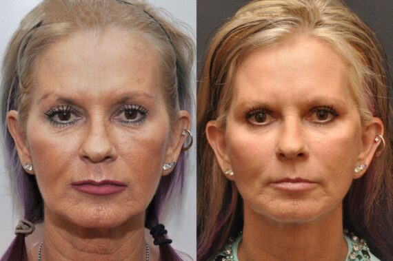 Minilift / Facelift Before and After Photos in Cincinnati, OH, Patient 7001