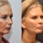 Minilift / Facelift Before and After Photos in Cincinnati, OH, Patient 7001