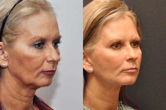 Minilift / Facelift Before and After Photos in Cincinnati, OH, Patient 7001