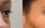 Cosmetic Injectables Before and After Photos in Cincinnati, OH, Patient 5524