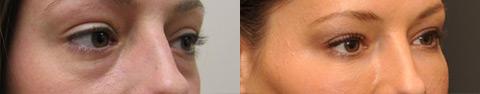 Cosmetic Injectables Before and After Photos in Cincinnati, OH, Patient 5524